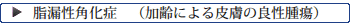 脂漏性角化症